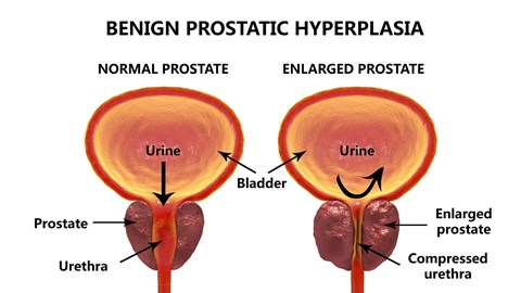 Prostatitis kezelési rendszer urodinamikai vizsgálat menete